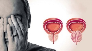 causes de la prostatite chez les hommes