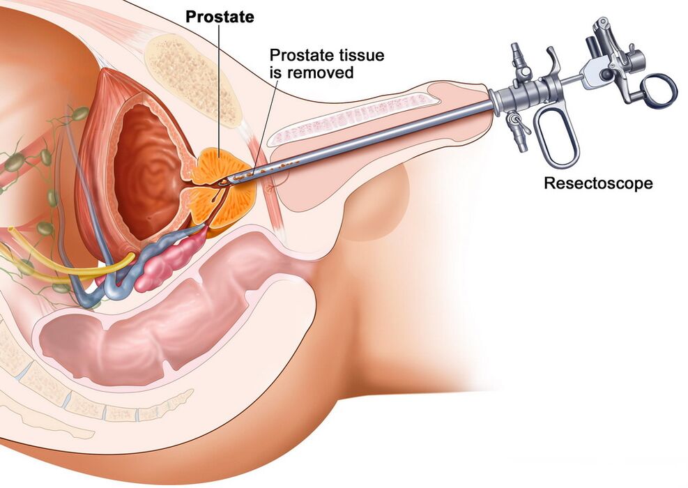 Prélèvement de tissu prostatique pour un diagnostic précis de la prostatite